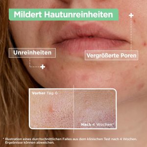 Mixa Anti-Unreinheiten Serum, Für zu Akne neigende und sensible Haut, Mit Salicylsäure, Squalan und Niacinamid, Geeignet für Gesicht & Hals, Hypoallergen, 30 ml 13